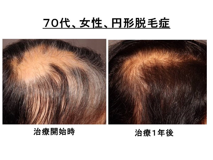 円形脱毛症　名医""